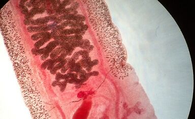 Anquilostomose em humanos