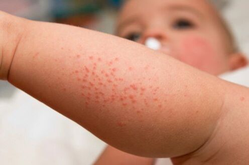 Alergia em criança como sintoma de presença de vermes