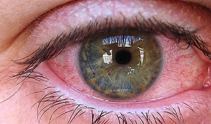 as razões para o aparecimento de parasitas nos olhos humanos